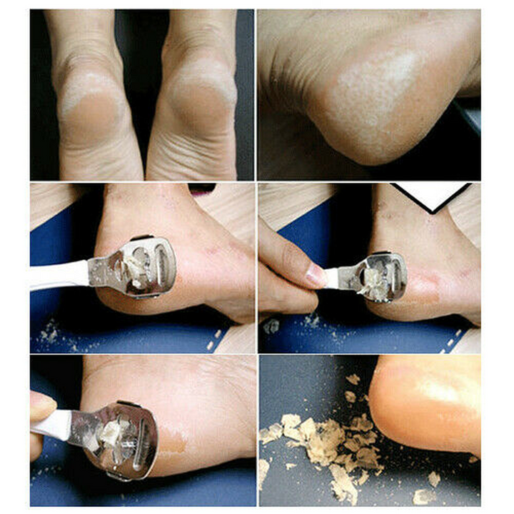 Skin Remover Corn Callus Slicer