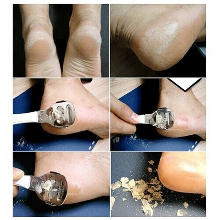 Skin Remover Corn Callus Slicer